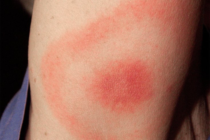 Lyme Disease Bullseye Rash 05142019